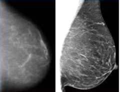 diferencias mamo digital