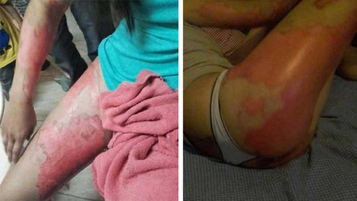 Un boxeador chaqueño roció con nafta y quemó a su&nbsp;novia