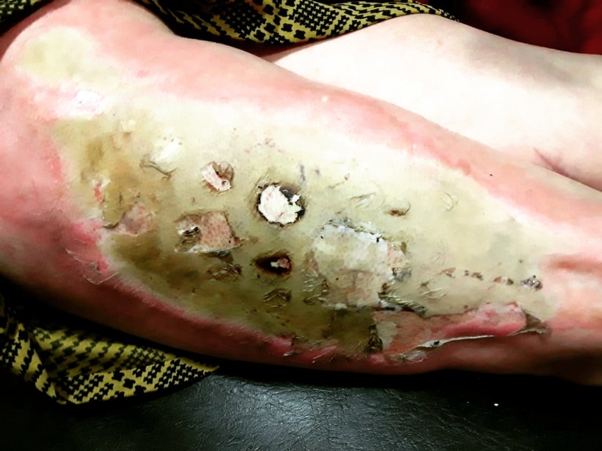 Se le incendió el vestido y le quemó la&nbsp;pierna